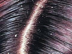 Выпадение волос перхоть лечение Афродита ТМ натуральная органическая косметика